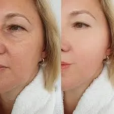 Fotomedicina estética: luz de precisión para restaurar la piel